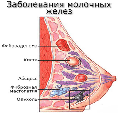 заболевания молочных желез.png заболевания молочных желез.png