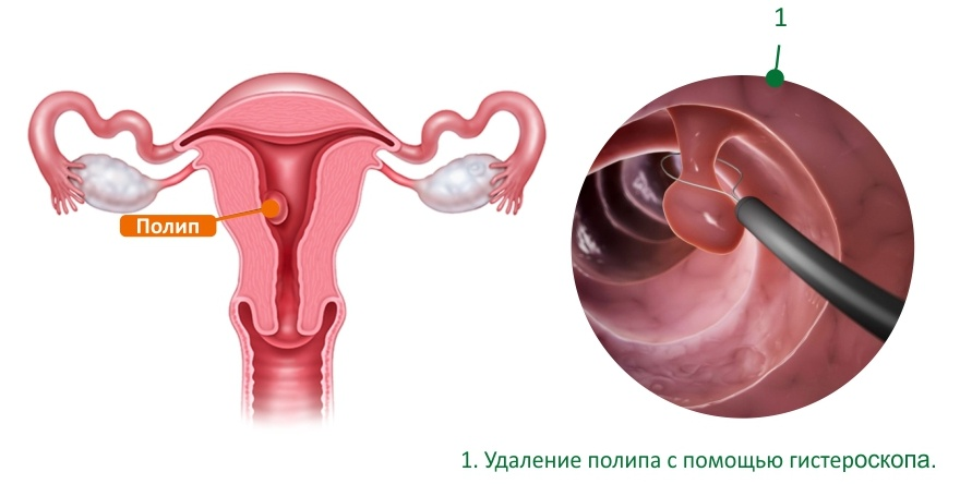 полип.png полип.png
