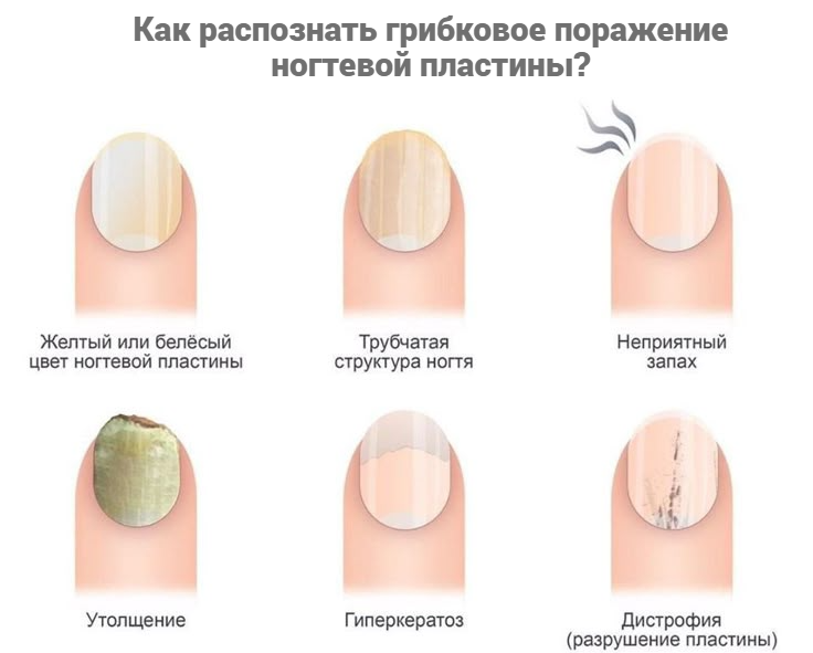 проявление грибка ногтей-fotor-20250604132119.png проявление грибка ногтей-fotor-20250604132119.png