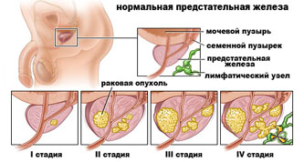 УЗИ предстательной железы.jpg УЗИ предстательной железы.jpg